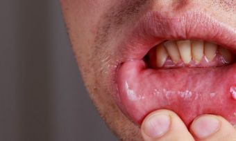 Mouth Ulcers: Painful Nuisance Or Something More Sinister?