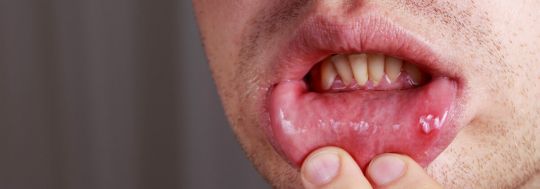 What Causes Mouth Ulcers