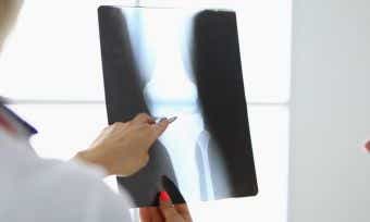 How much does a knee replacement cost?