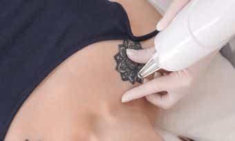 Laser tattoo removal: What does it cost if you rethink the ink?