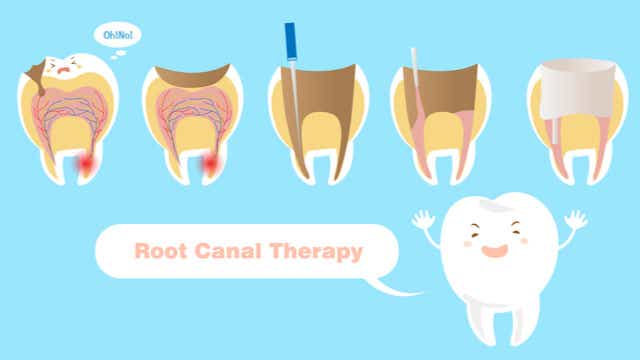 Cost of Root Canal Therapy 