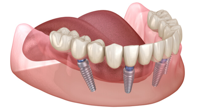 What Is An All-On-4 Implant?