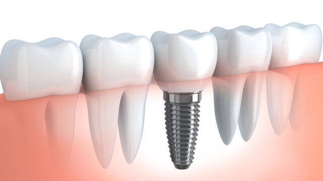 What Is A Dental Implant?