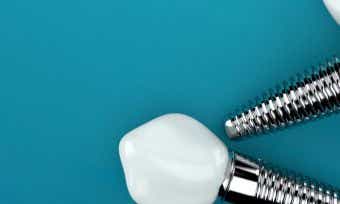 Dental implants - we drill down into the potential costs